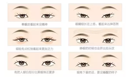 關(guān)于重瞼術(shù)，你要了解的那些事兒