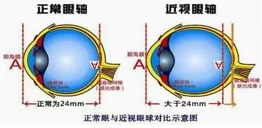 近視眼球突出？！控制近視度數(shù)加深是關(guān)鍵！