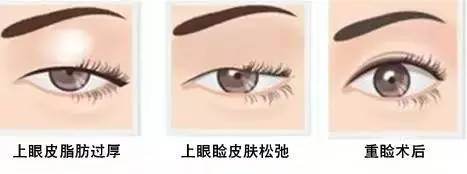 為什么要做雙眼皮？5個理由說服你！