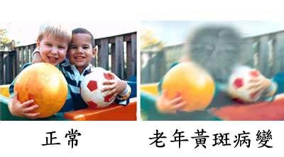 黃斑變性與老花眼，兩者不一樣！