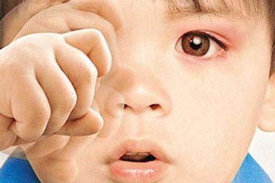 秋季紅眼病高發(fā)，當(dāng)心孩子被傳染