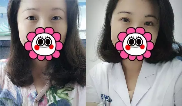 要不要做雙眼皮？別糾結(jié)了看這個！