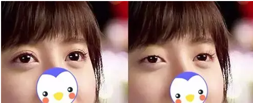 要不要做雙眼皮？別糾結(jié)了看這個！