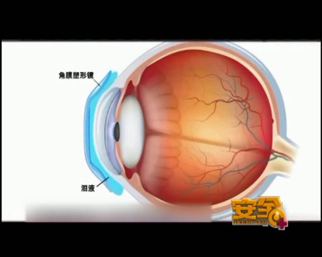 一夜之間真的能改變視力嗎？