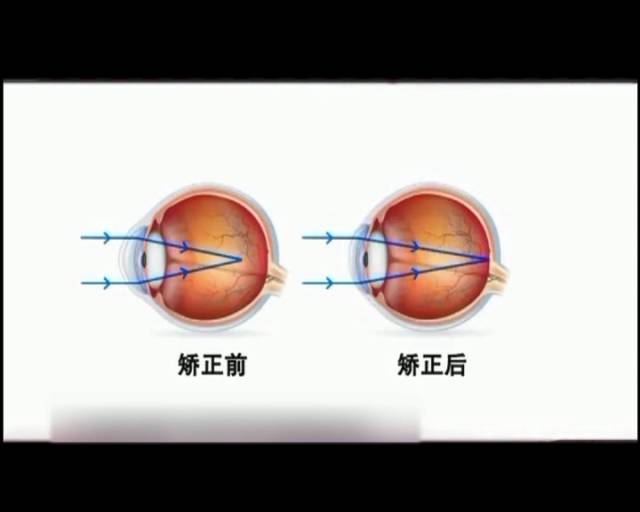 一夜之間真的能改變視力嗎？
