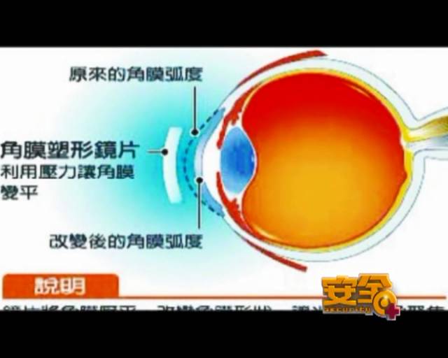 一夜之間真的能改變視力嗎？