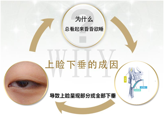 拯救惺忪睡眼，告別上瞼下垂！