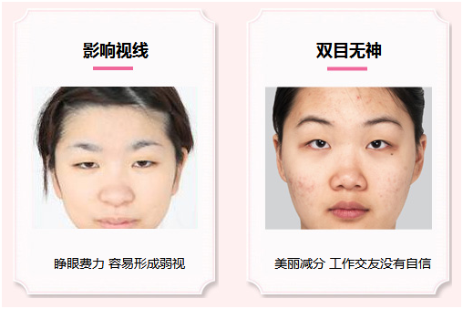 拯救惺忪睡眼，告別上瞼下垂！