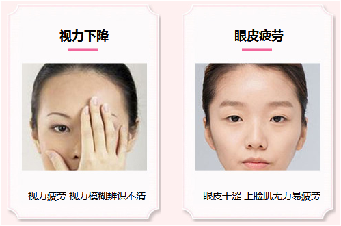 拯救惺忪睡眼，告別上瞼下垂！
