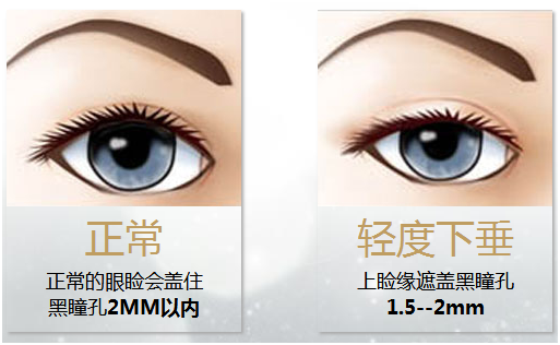 拯救惺忪睡眼，告別上瞼下垂！