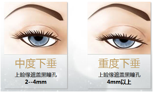 拯救惺忪睡眼，告別上瞼下垂！