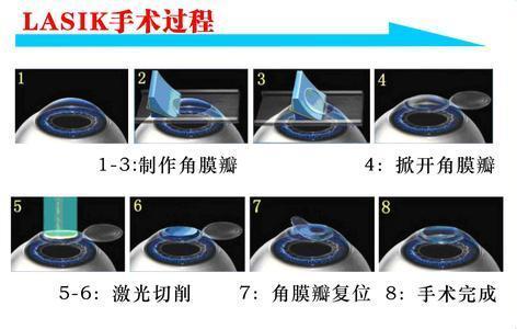 他們很有錢(qián)，但寧愿戴眼鏡都不做近視手術(shù)