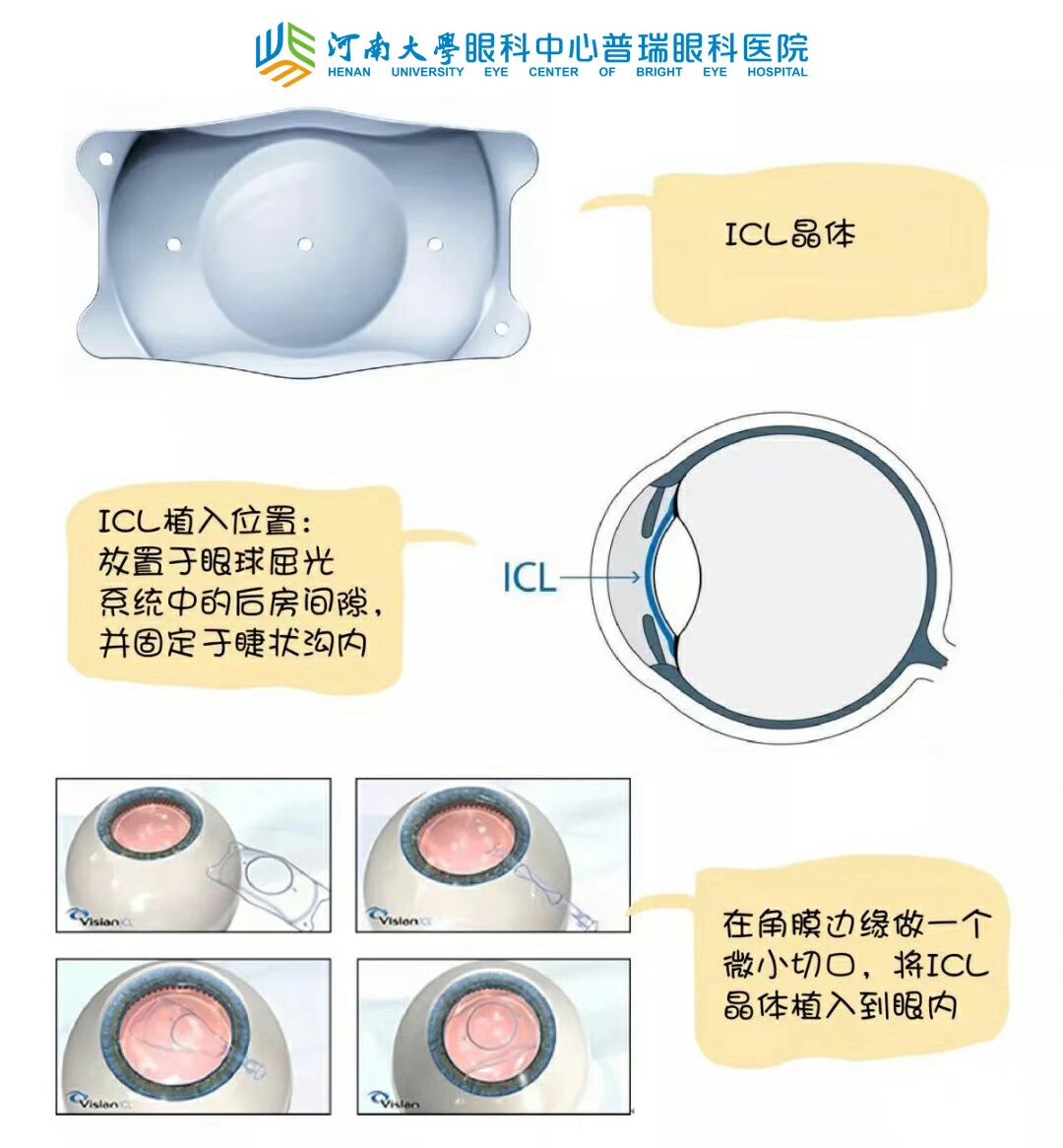 近視度數(shù)太高，還能做手術(shù)嗎？