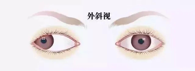 關于斜視，這幾個誤區(qū)害人不淺!