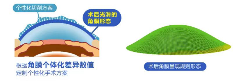 微雕優(yōu)視飛秒，重新定義角膜屈光手術(shù)，讓視力多看一行！