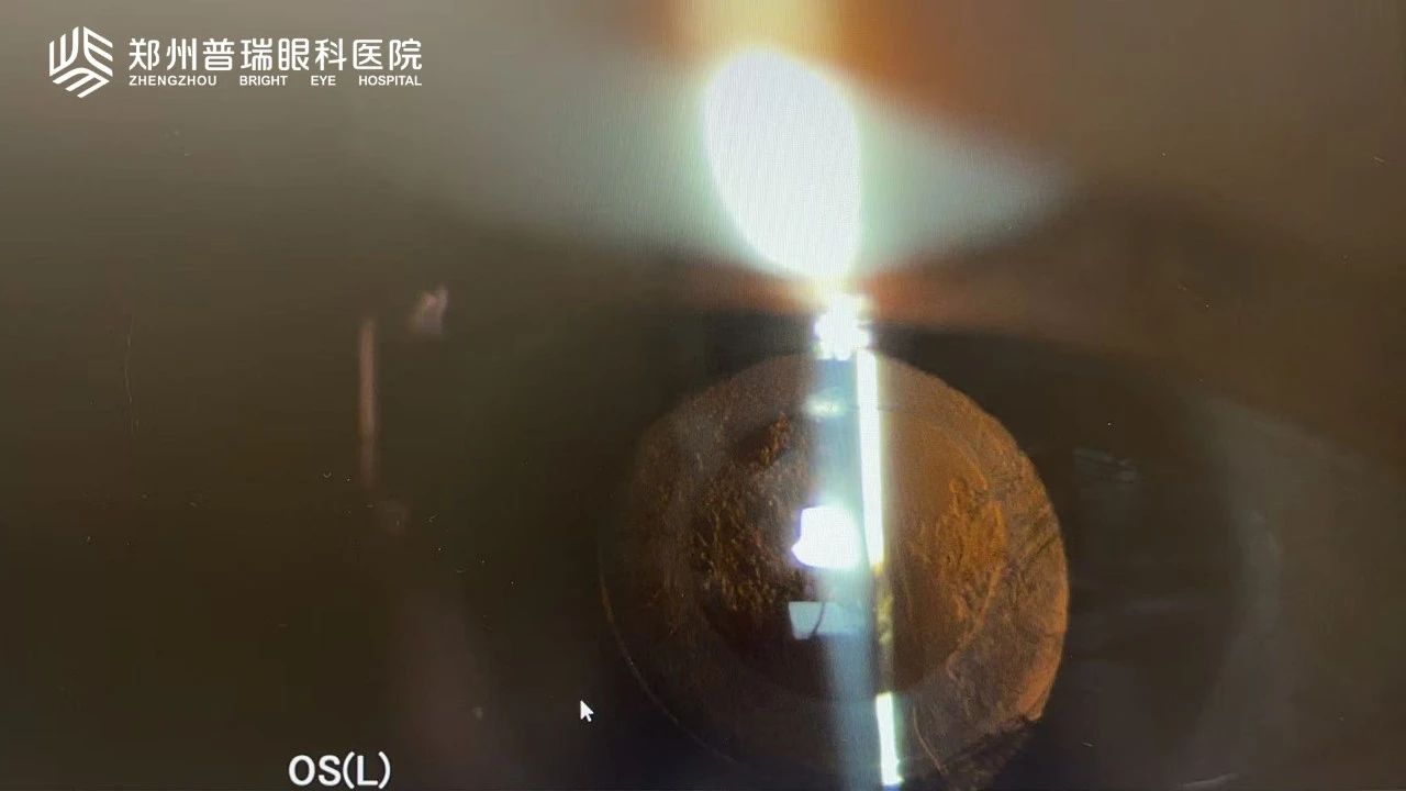 白內(nèi)障術(shù)后視力又下降？6大原因多方面解析！
